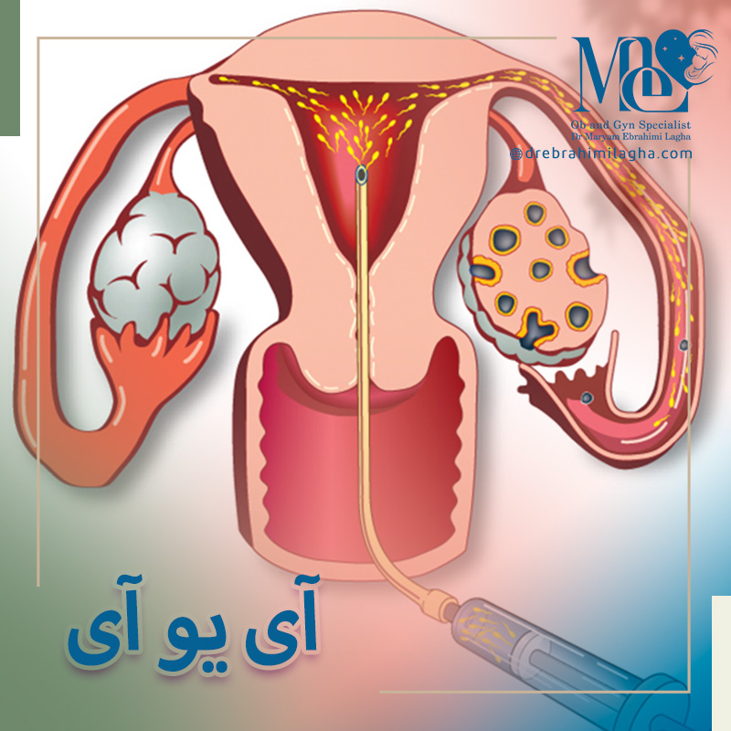آی یو آی