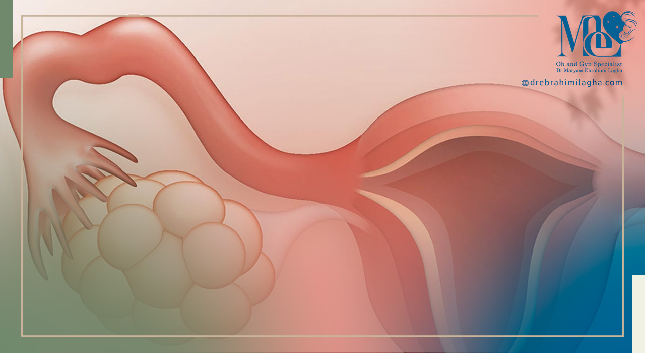 علائم شایع تنبلی تخمدان