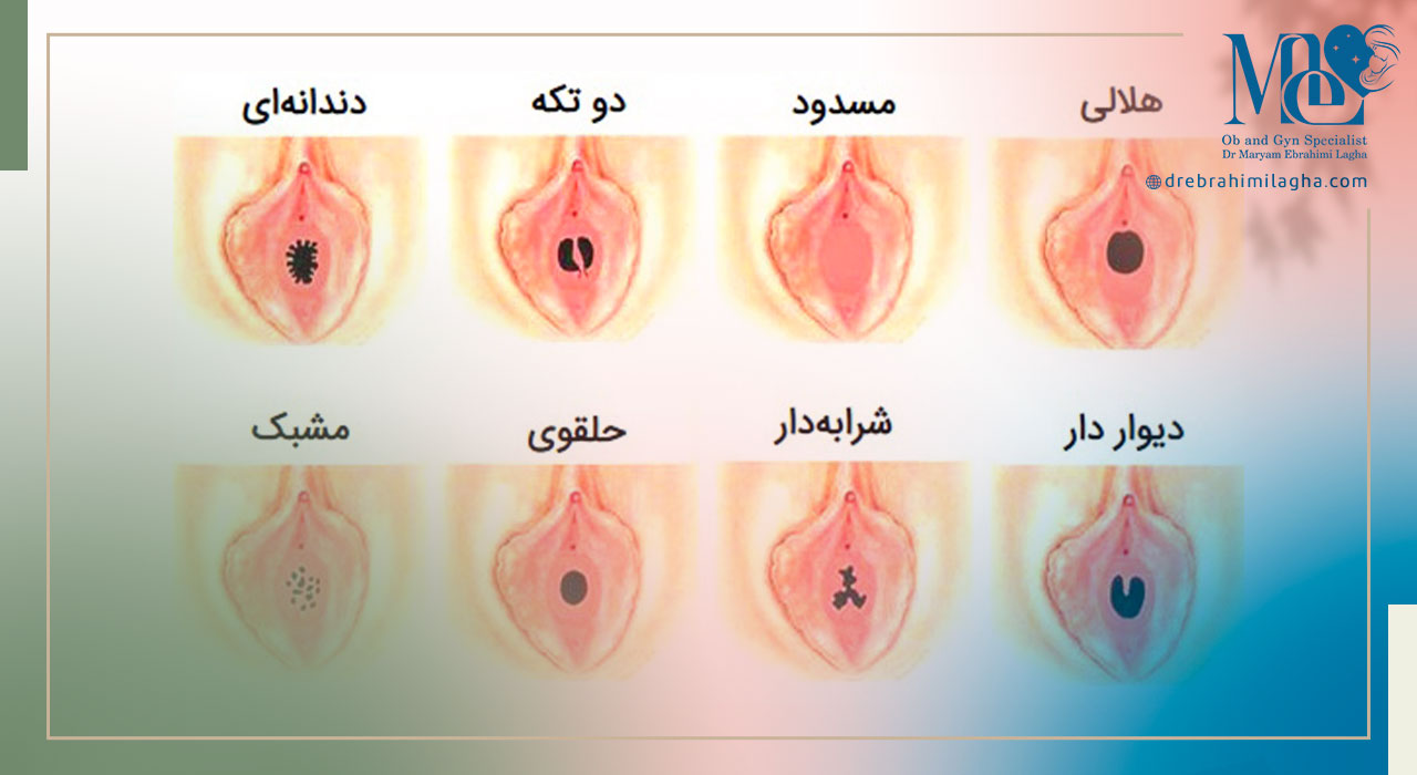 انواع پرده بکارت - انواع و ساختار آن - دکتر مریم ابراهیمی لقا