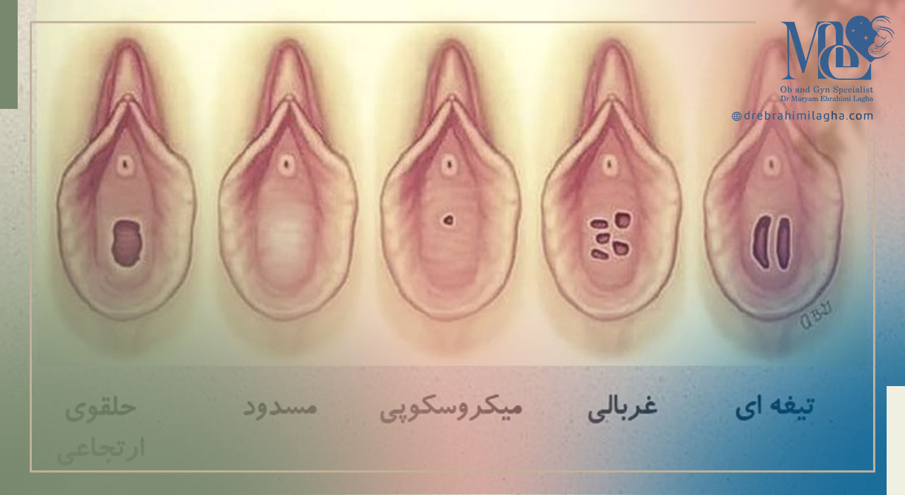 هر آنچه که باید در مورد پرده بکارت ارتجاعی بدانید